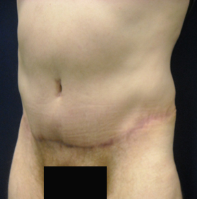 Chicago Abdominoplasty Tummy Tuck 